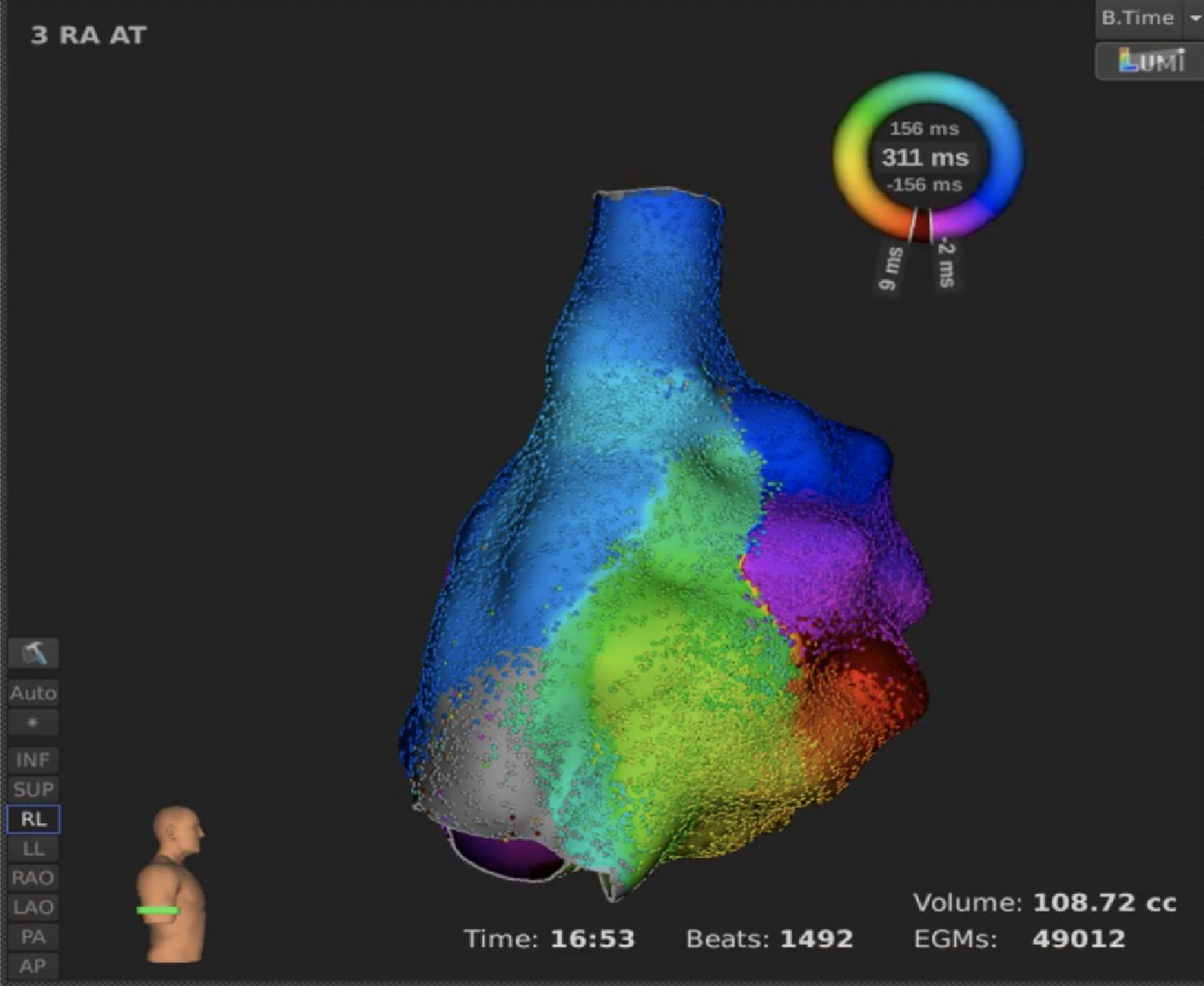 Cardiac Mapping System Software RHYTHMIA HDx Boston Scientific